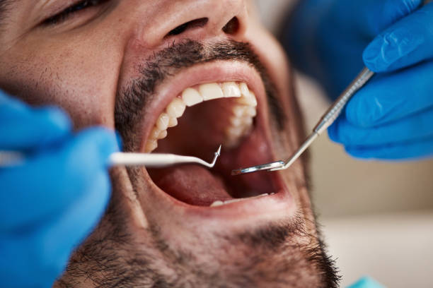 Best Emergency Dentist for Lost Fillings or Crowns in South Burlington, VT